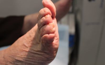 Dedos en Garra: Causas. síntomas y tratamientos efectivos.