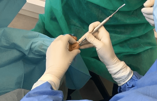 Exostosis subungueal