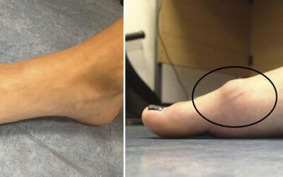 Hallux Rigidus: causas, síntomas y tratamientos