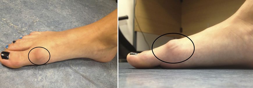 Hallux Rigidus: causas, síntomas y tratamientos
