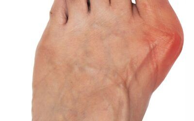 ¿Qué es el Hallux Valgus o Juanete?